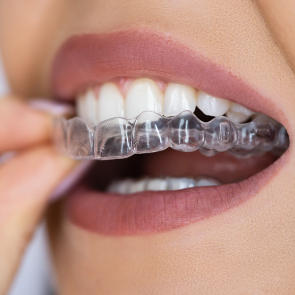 clear aligners